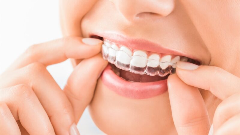What is the ideal Time to Get Invisalign?