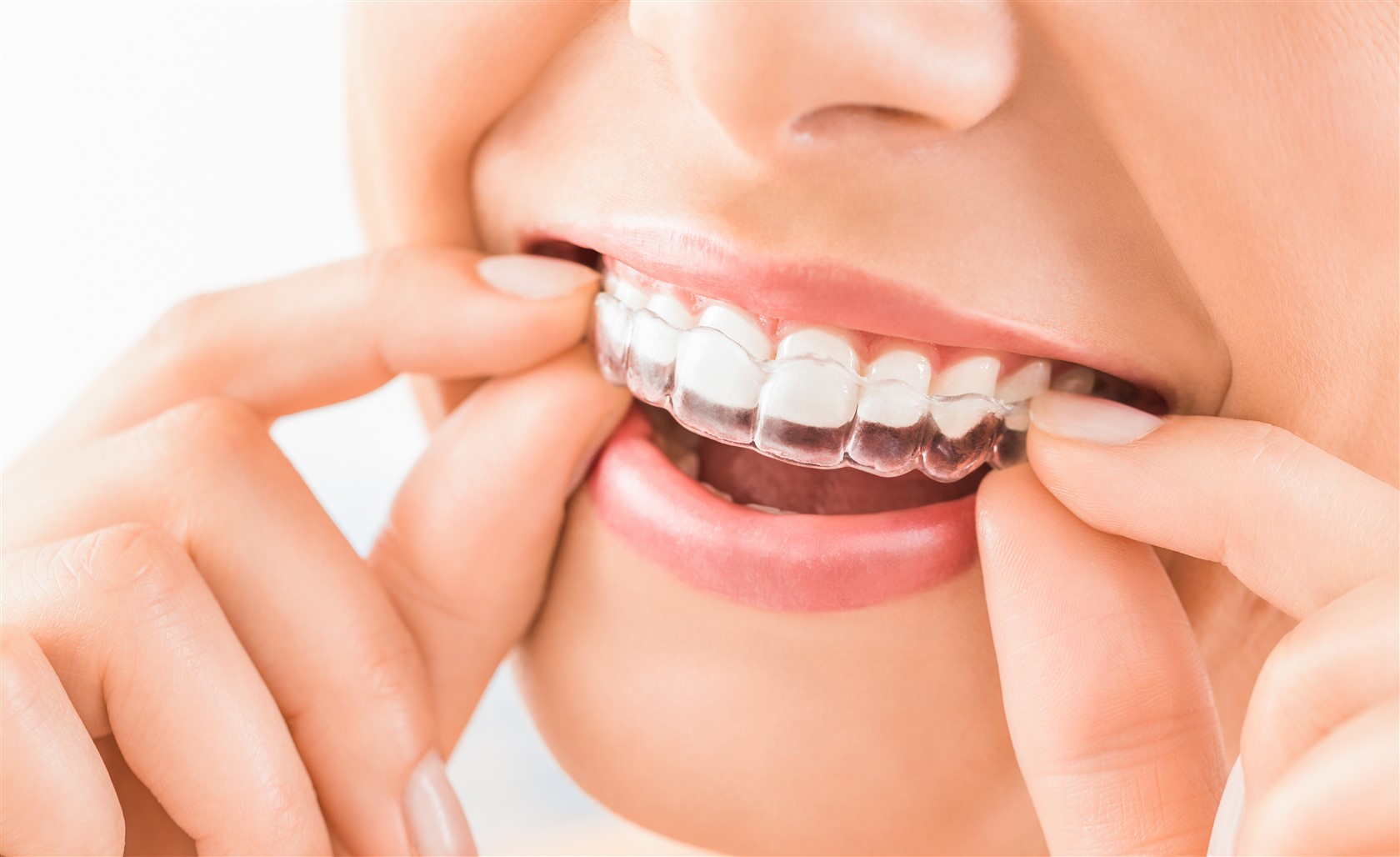 What is the ideal Time to Get Invisalign?